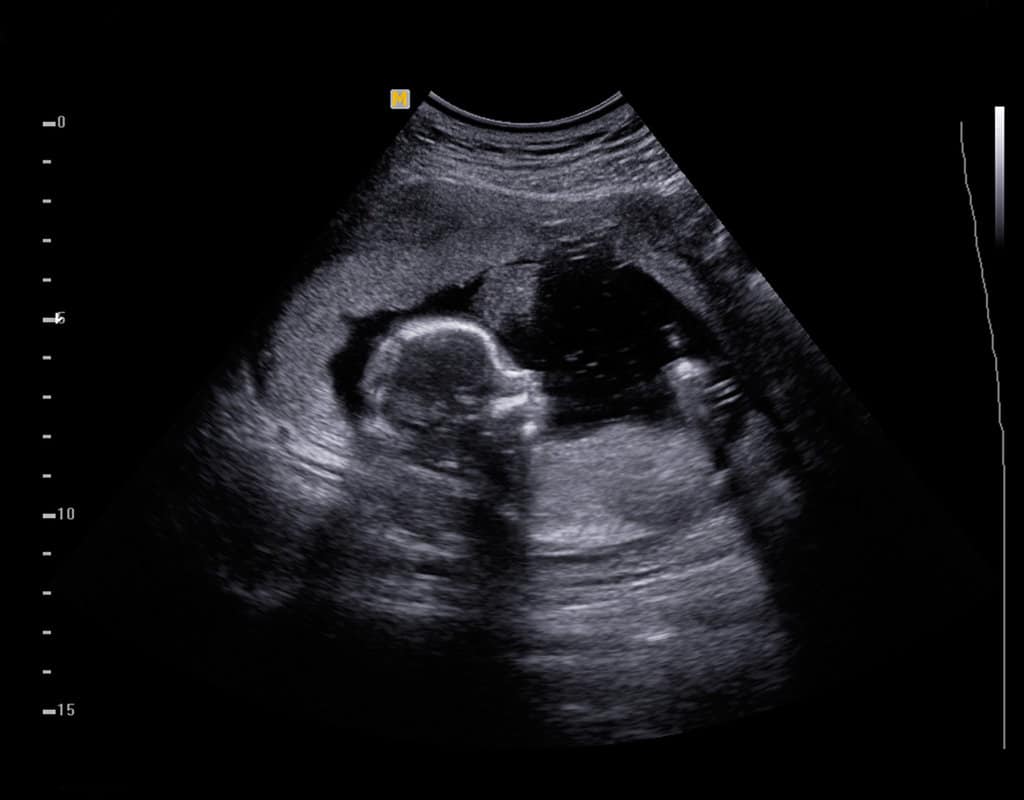 échographie d'un bébé de 5 mois dans le ventre de sa mère