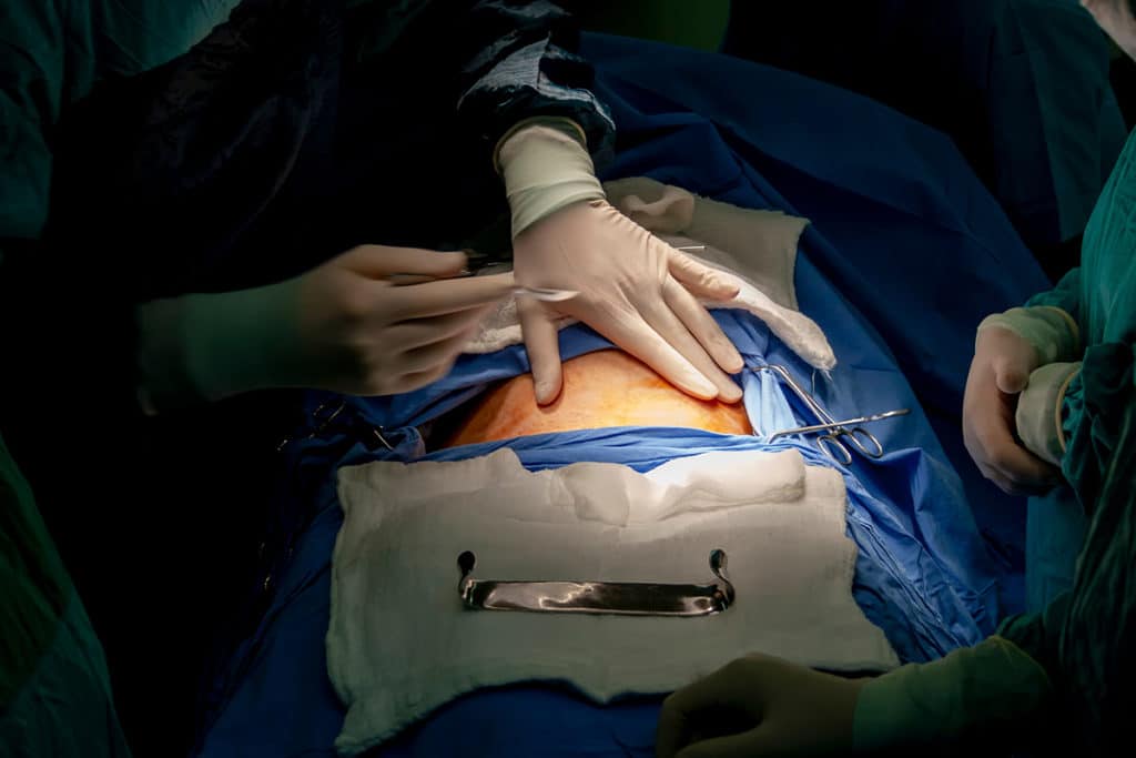 opération de césarienne en cours avec 2 mains gantées d'un chirurgien prêt à faire l'incision