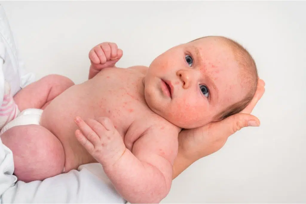 un bébé porté dans les bras est recouvert de boutons et rougeurs.