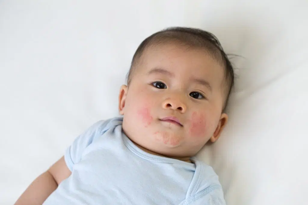 un bébé asiatique est allongé et porte un body manches courtes bleu. il a les joues et le menton recouverts de plaques rouges.