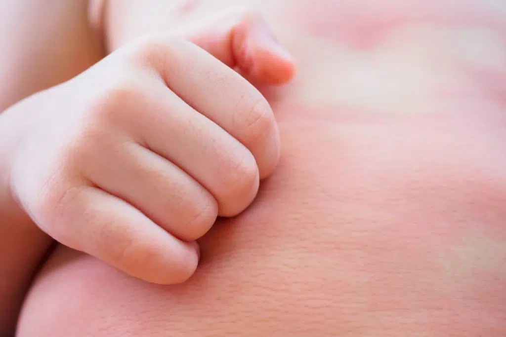 vue rapprochée d'une main qui gratte des rougeurs sur la peau d'un bébé